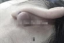 Cô gái cắt bỏ sẹo lồi to bằng hạt lạc vì xỏ khuyên tai